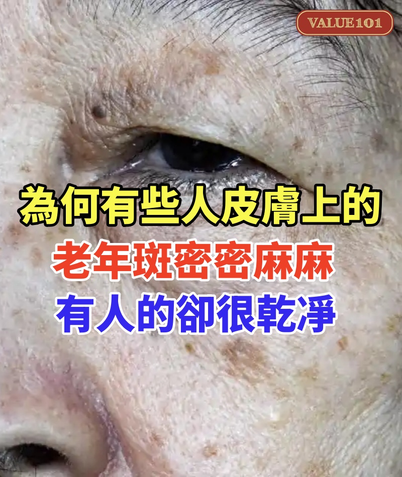 都是50歲!為何有些人皮膚上的老年斑「密密麻麻」有的卻很乾凈!醫生說出實情